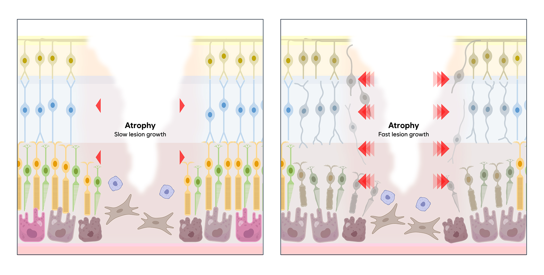 Paradigm shift in geographic atrophy progression: RPE-centric vs extended photoreceptor perspective